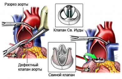Замена аортального клапана