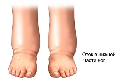 Амилоидоз - отек в нижней части ног