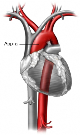 Расслоение аорты - кровеносные сосуды