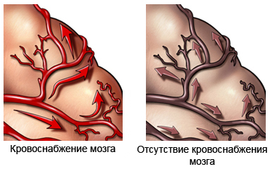 Сосудистая деменция - кровоснабжение мозга