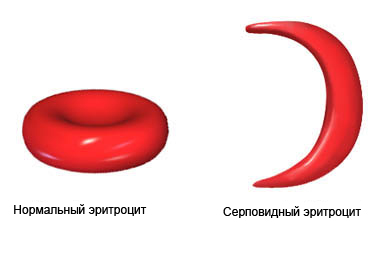 Серповидноклеточная анемия - эритроцит