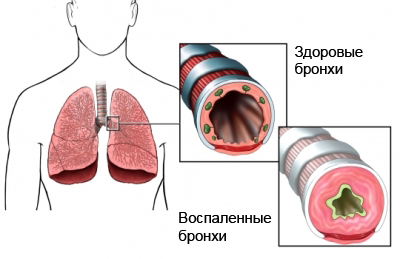 Воспаленные бронхи - причина приступов астмы