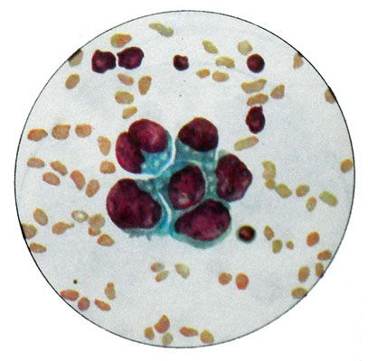 Высокодифференцированная аденокарцинома матки - опухолевые клетки в виде розетки
