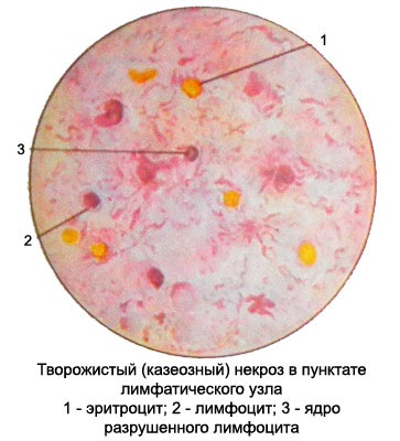 Творожистый (казеозный) туберкулез - пунктат лимфатического узла