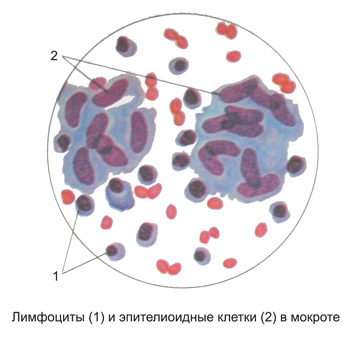 Лимфоциты и эпителиоидные клетки в мокроте