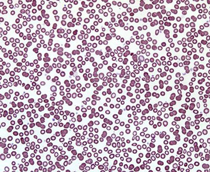 Железодефицитная анемия - картина крови