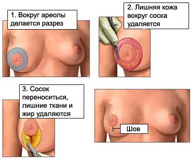 Уменьшение груди - Пластическая операция уменьшения молочной железы - Редукционная маммопластика
