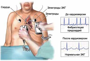 Cardioversion/Defibrillation