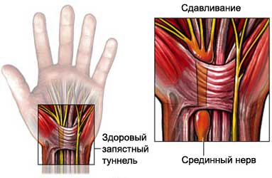 Инъекция при туннельном синдроме кисти руки