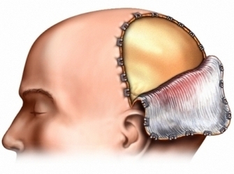 Трепанация черепа - Краниотомия