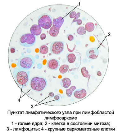 Lymphoblastischen Lymphosarkom - punctata Lymphknoten