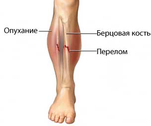 Перелом ноги