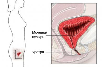 Надлобковая цистостомия - процедура, выполняемая для опорожнения мочевого пузыря