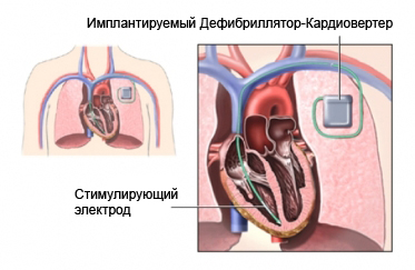 Имплантируемый дефибриллятор-кардиовертер