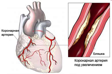 Стенокардия - блокировка коронарной артерии