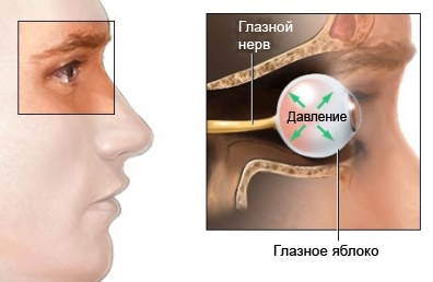 Глаукома - методы лечения глаукомы