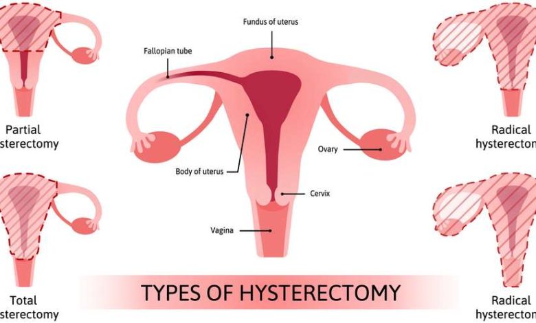 Гистерэктомия лапароскопическая, удаление матки: что это за операция, причины, противопоказания, как делают, что после