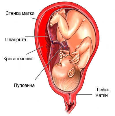 Отслоение плаценты