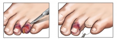 Ампутация поврежденного пальца ноги
