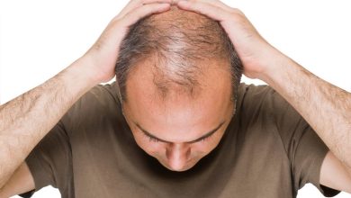Alopecia, (hårtap, skallethet): hva er dette, årsaker, symptomer, komplikasjoner, diagnostikk, behandling, forebygging