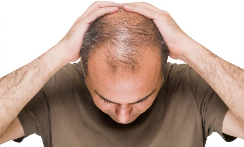 Hiustenlähtö, (hiustenlähtö, kaljuuntuminen): mikä tämä on, syyt, oireet, komplikaatioita, diagnostiikka, hoito, ennaltaehkäisy