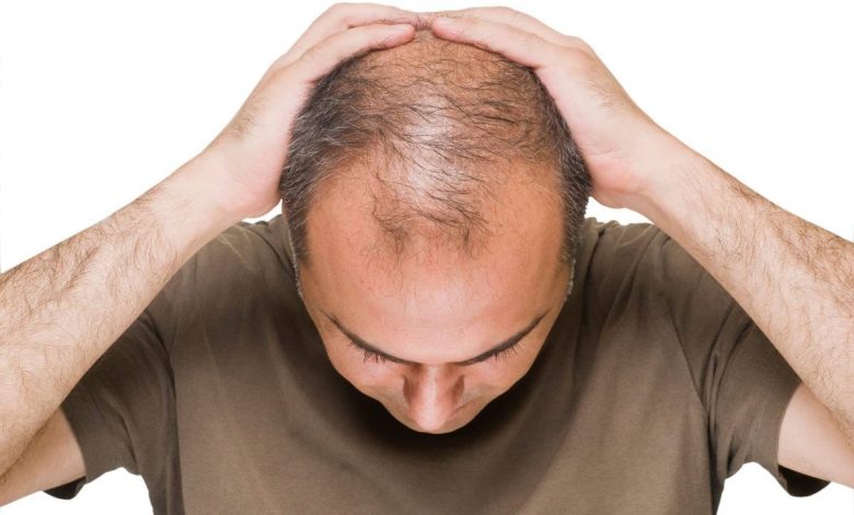 Alopecia, (rambut rontok, kebotakan): apa ini, Penyebab, Gejala, komplikasi, diagnostik, pengobatan, pencegahan