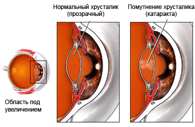 Болезнь Фабри - катаракта