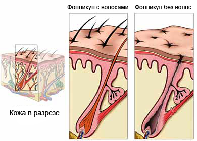 Облысение - гибель фолликула