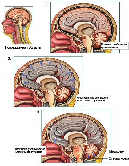 Этапы отмирания мозга