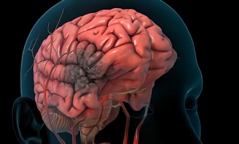 Dany cerebral anòxic: què és això, la causa de la, símptomes, diagnòstic, tractament, prevenció