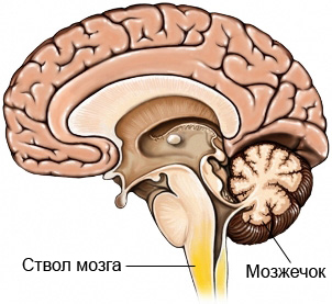 Синдром Арнольда-Киари - мозжечок и ствол мозга