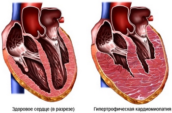 Гипертрофическая кардиомиопатия - одна из причин пересадки сердца