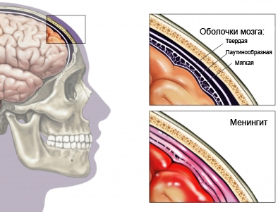 Бактериальный менингит - воспаление оболочек мозга