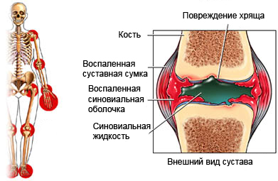 Ревматоидный артрит