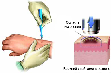 Биопсия кожи - удаление небольшой части патологической кожи