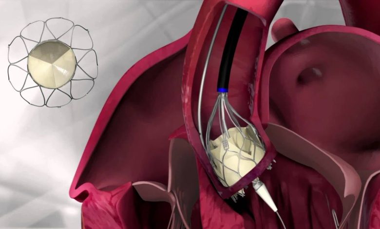 Keitimas aortos vožtuvo: kas tai per operacija, priežastys, Kontraindikacijos, kaip jie daro, kas po