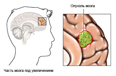 Опухоль головного мозга