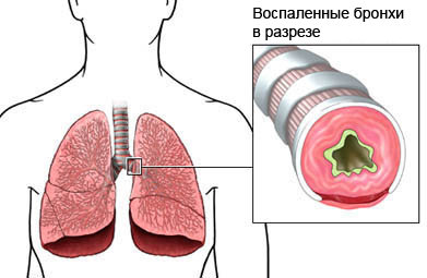 Воспаление бронхов может осложнить приступы астмы