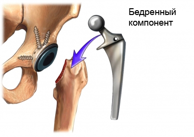 Установка протеза тазобедренного сустава