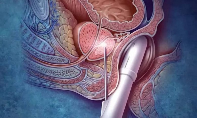 Prostatы biopsie: Quelle est la procédure, les causes, Contre-, comment ils font, et après