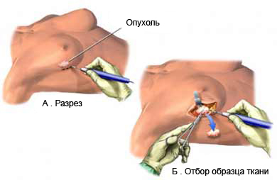 Биопсия груди открытая - Биопсия груди хирургическая