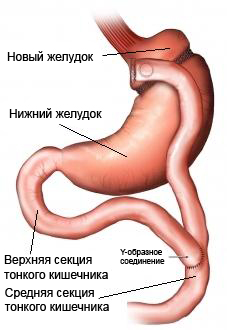 Обходной желудочный анастомоз по Ру - открытая операция