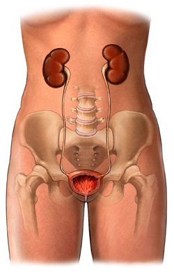 Borttagning av urinblåsan - njurar, urinledarna, urinblåsa