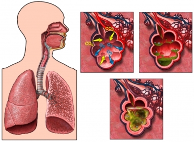 Развитие пневмонии в воздушных мешках легких