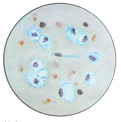 Зернистые шары - ксантомные клетки в спинномозговой жидкости