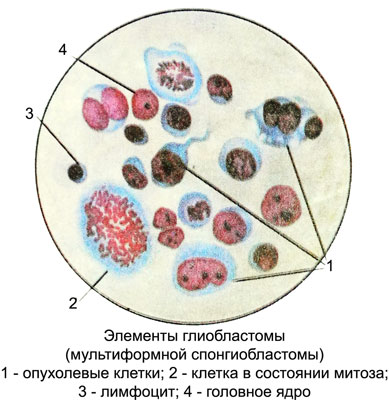 Клетки глиобластомы в спинномозговой жидкости