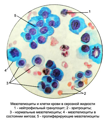 Мезотелиоциты в серозной жидкости