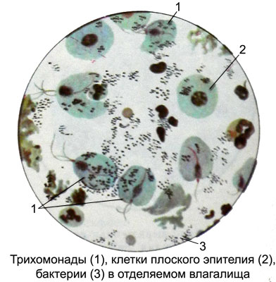 Трихомонады и бактерии в содержимом влагалища