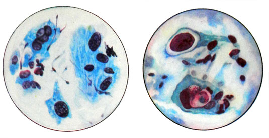 Варианты цитологической картины плоскоклеточного эпителия рака шейки матки