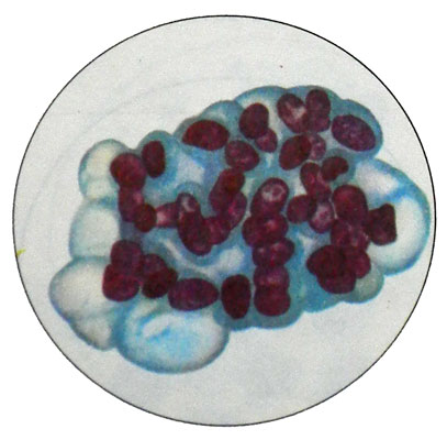 Высокодифференцированная аденокарцинома матки - симпласт из опухолевых клеток
